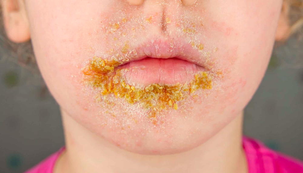 impetigonaotroku.jpg